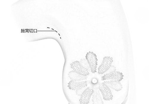 假体隆胸哪个切口好？恢