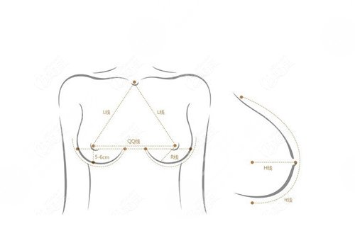 假体隆胸哪个切口好？恢