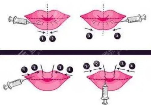 唇部注射玻尿酸多久可以恢复?