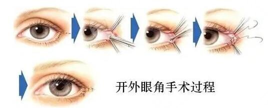 开眼角手术预防疤痕应该怎样去做好护理?
