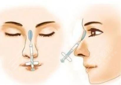 玻尿酸隆鼻有副作用吗