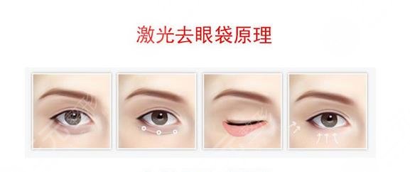 广州健丽去眼袋案例