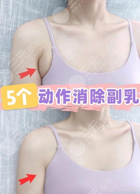 腋下副乳运动消除方法