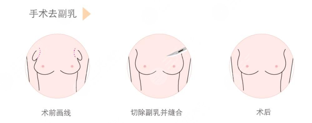 腋下副乳运动消除方法