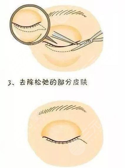 水剥离祛眼袋是什么?原理介绍&收费价格&术后护理注意事项