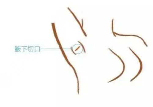 隆胸腋下切口的优势和缺点有哪些?