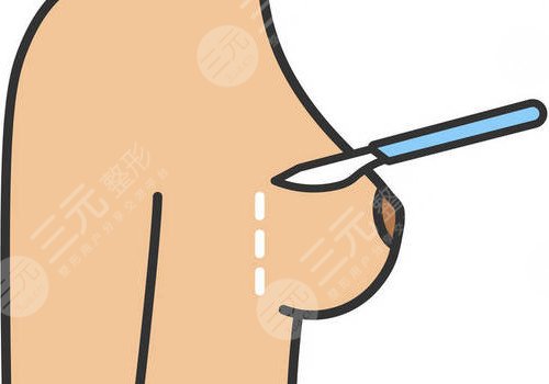 隆胸腋下切口的优势和缺点有哪些?