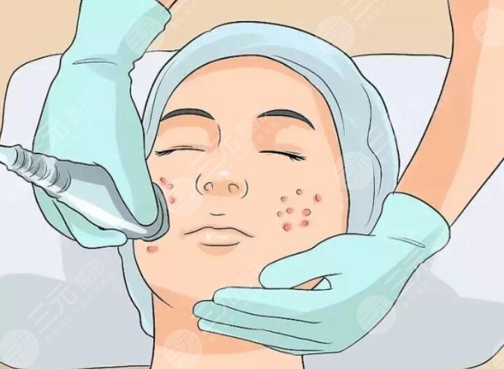 激光磨皮去痘印多少钱一般?