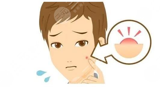 激光去痘印之后应该怎样去护理?