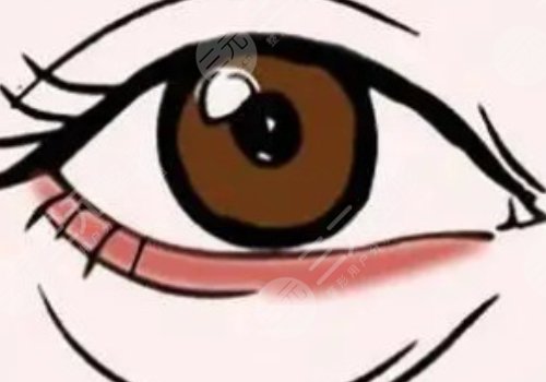 注射卧蚕后会变成眼袋吗？