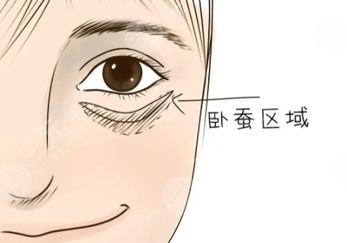 注射卧蚕后会变成眼袋吗？