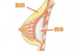 假体丰胸如何避免包膜痉挛？3-6个月的恢复期要注意护理！