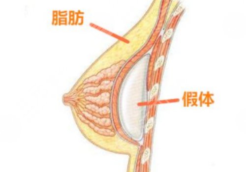 假体丰胸如何避免包膜痉挛？