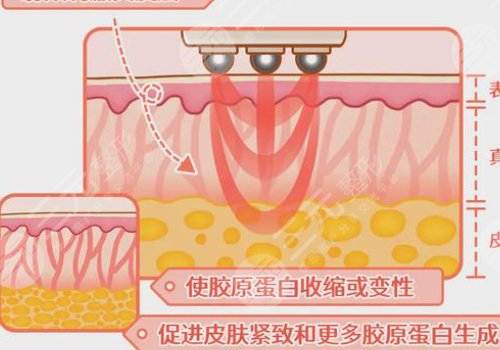 热玛吉成都授权机构有哪些?