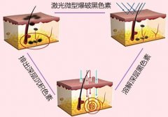 哪种激光祛斑效果好？美肤净暇指南！
