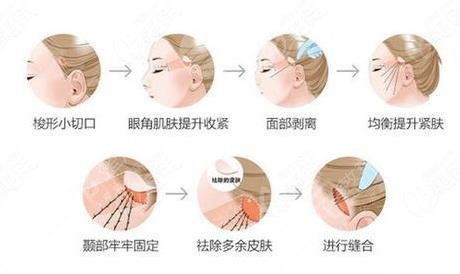 小切口提拉怎么做的？