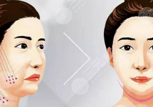 脸部轮廓固定怎么做？