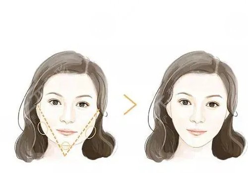 脸部轮廓固定怎么做？