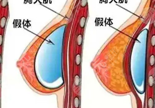 毛面假体隆胸多久变软?
