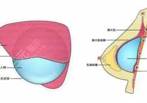 光面假体隆胸后需要怎么样按摩？