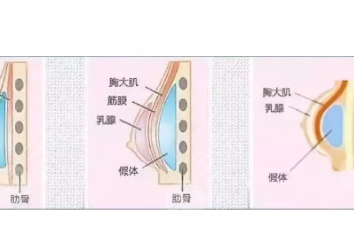 光面假体隆胸后需要怎么样按摩？