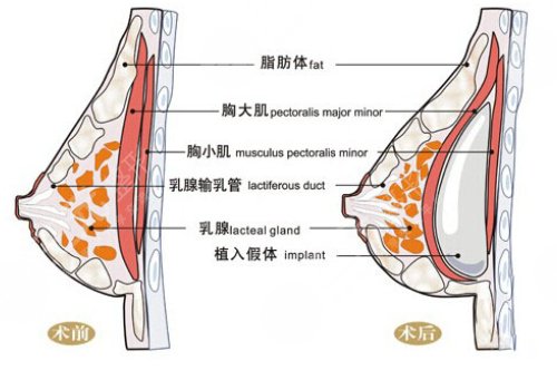 光面假体隆胸后需要怎么样按摩？