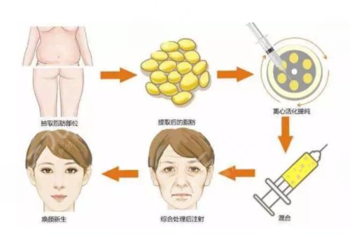 面部脂肪填充的好处和坏处有哪些