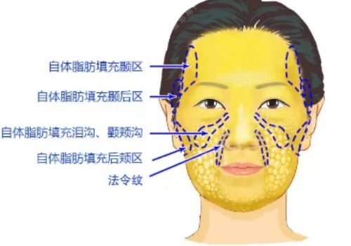 面部脂肪填充的好处和坏处有哪些