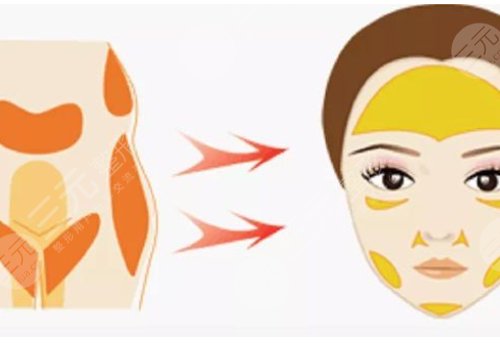 面部脂肪填充的好处和坏处有哪些