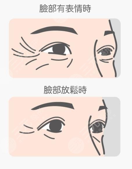 祛除鱼尾纹快的方法有哪些?