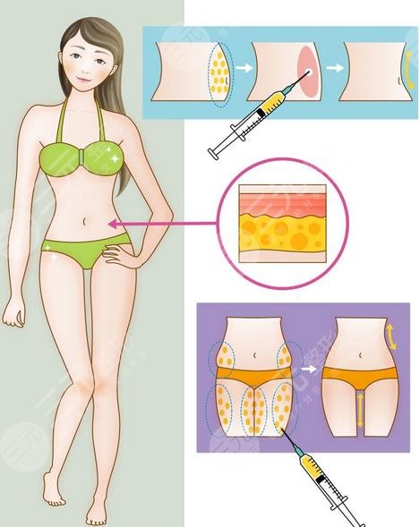 上海伯思立吸脂案例