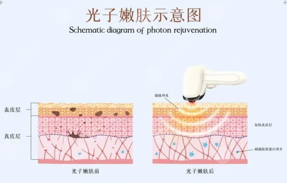 光子嫩肤祛斑效果如何