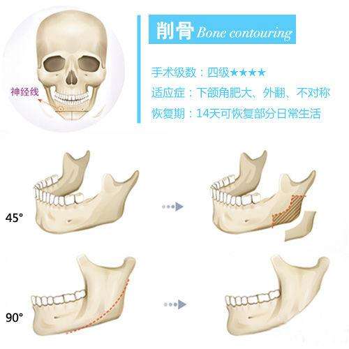 磨骨和削骨的区别是什么？手术方法科普，颌面整形必修课！