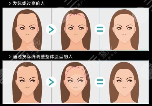 纹发际线和植发哪个好？区别对比分析！术前必看~