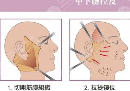 小拉皮和大拉皮的区别在哪里？