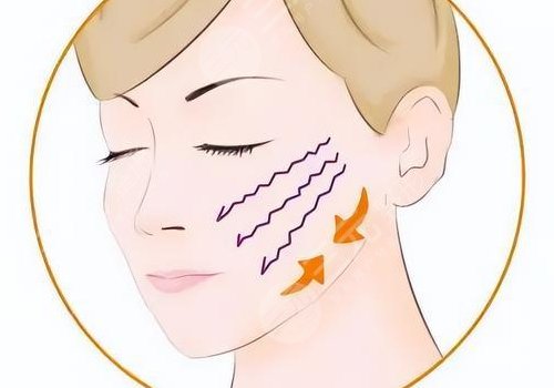 轮廓整形1个月和6个月对比图