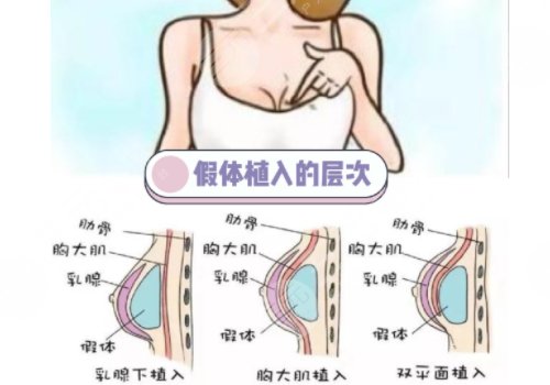 毛面假体和光面假体哪个好?