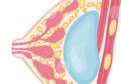 毛面假体和光面假体哪个好?