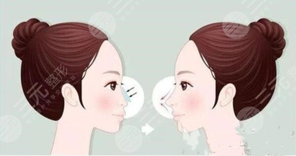 做完妈生鼻或者是直鼻微翘手术之后需要注意什么?