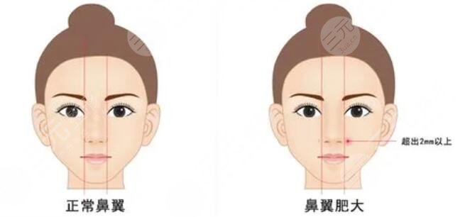 鼻翼缩小手术的注意事项