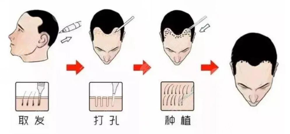 植发