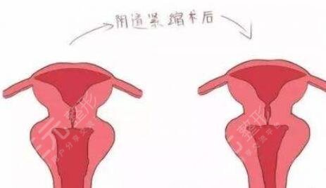 私密紧缩