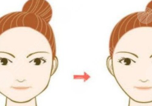 国字脸削骨手术一般多少钱？