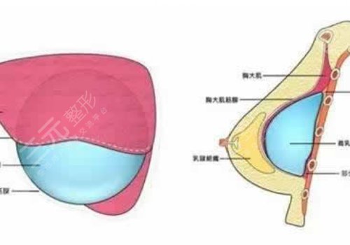 光面假体和毛面假体的优缺点