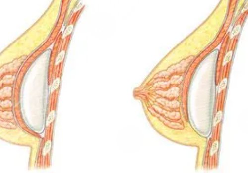 光面假体和毛面假体的优缺点