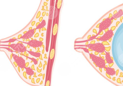 光面假体和毛面假体的优缺点