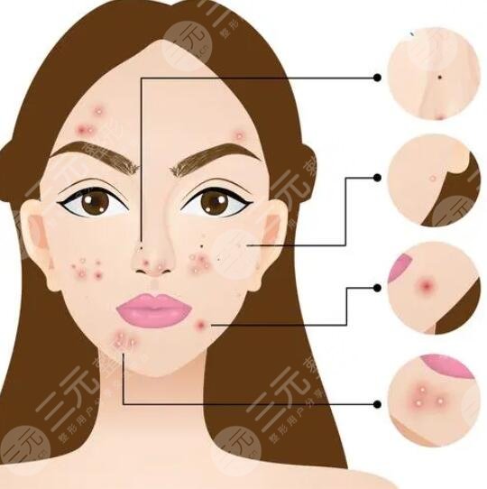 去痘印要多少钱一次?