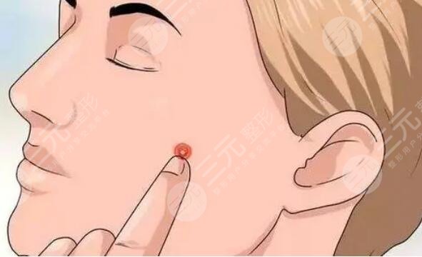 祛痘印期间吃什么好?