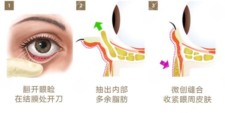 外切眼袋一般要多久才能完全恢复