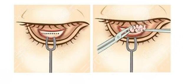 外切眼袋一般要多久才能完全恢复